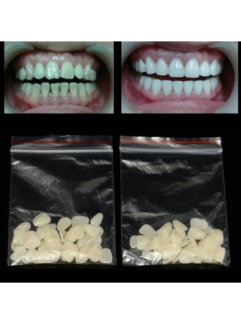 Ультратонкие виниры для верхних передних зубов (100 шт.)